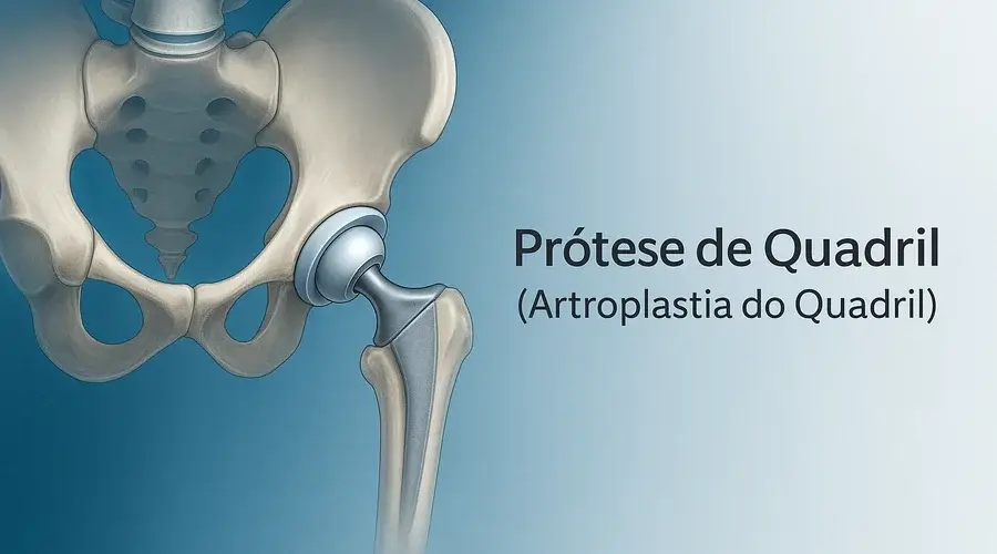 Prótese de Quadril (Artroplastia do Quadril)