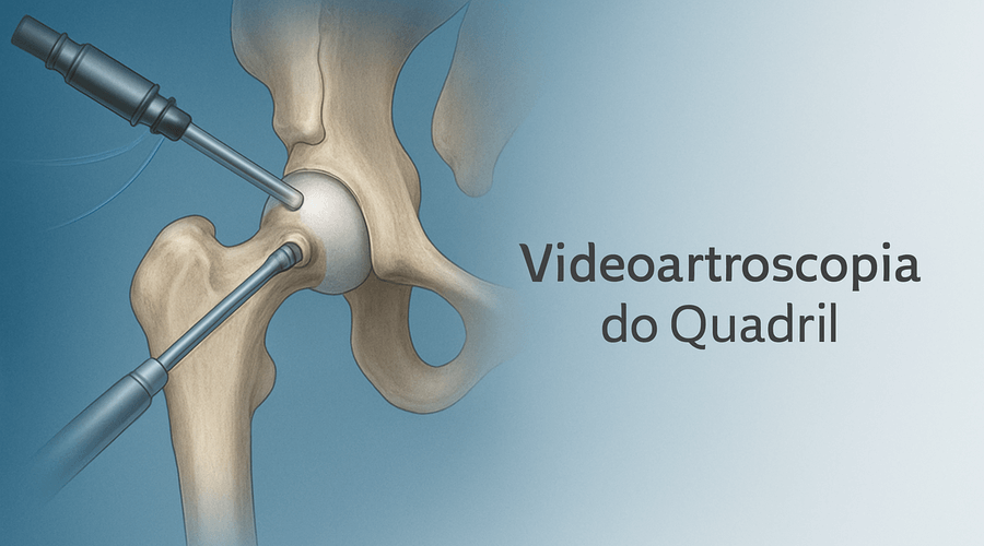 Videoartroscopia do Quadril