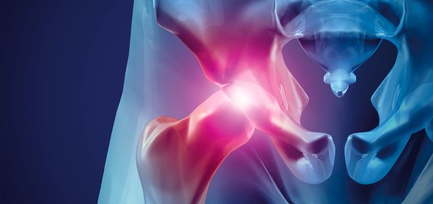 Lesão Labral do Quadril