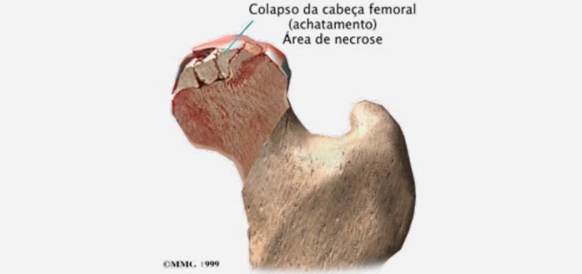 Necrose Avascular da Cabeça Femoral (Quadril)