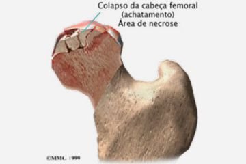 Necrose Avascular da Cabeça Femoral (Quadril)